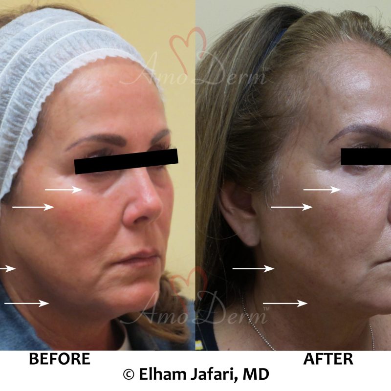 Liquid facelift with filler injection