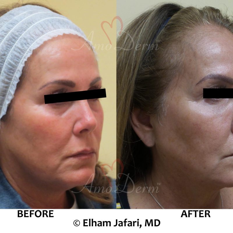 Liquid facelift with filler injection