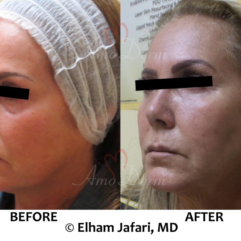 Liquid facelift with filler injection