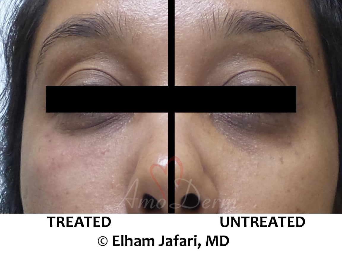 Treat dark circles & bags under eyes using fillers & lasers