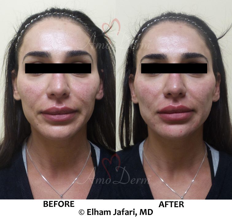 PDO thread lift for cheeks as part of liquid facelift