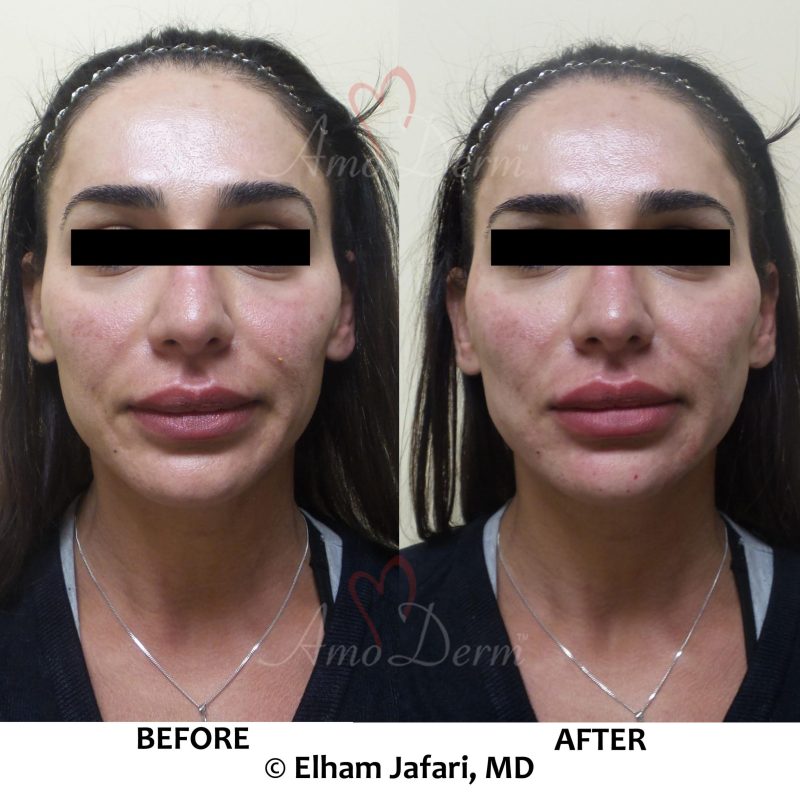 PDO thread lift for cheeks as part of liquid facelift PDO thread lift for cheeks as part of liquid facelift