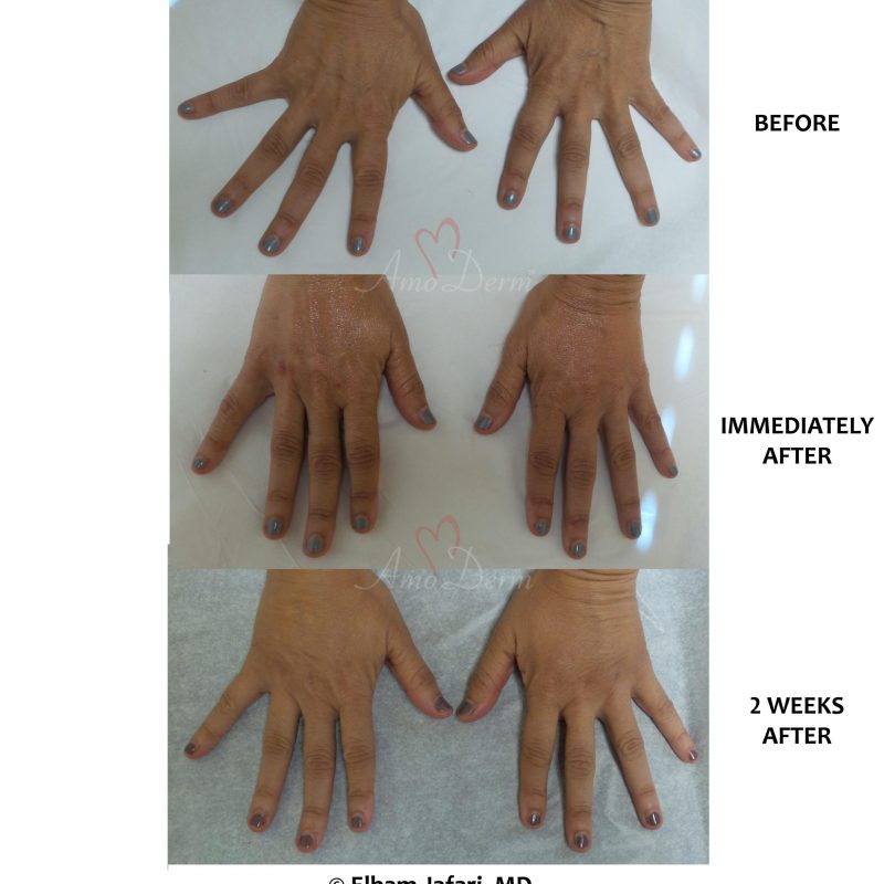 Hand rejuvenation with dermal filler injection