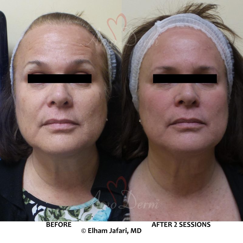 Microlaser Peel - Erbium laser skin resurfacing
