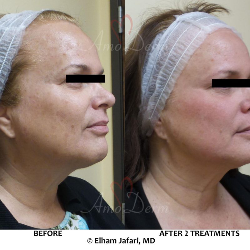Microlaser Peel - Erbium laser skin resurfacing
