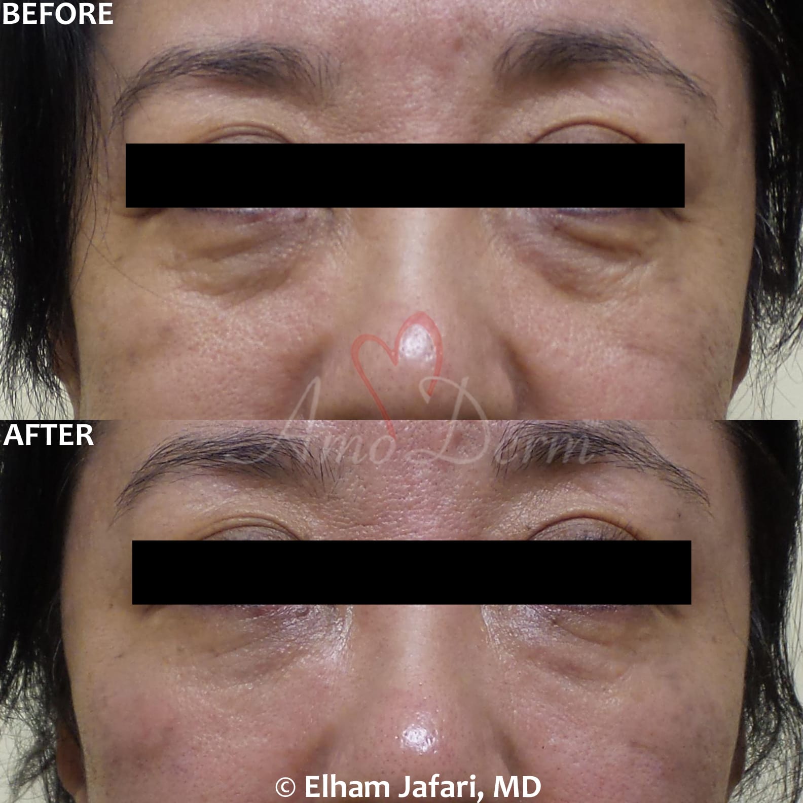 Treat dark circles & bags under eyes using fillers & lasers
