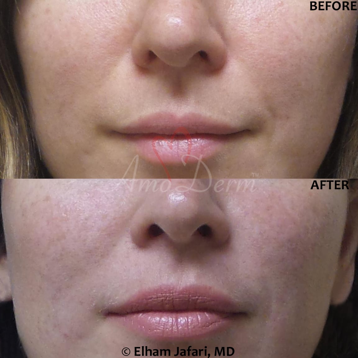 Bellafill (Artefill), the Beauty that Lasts Collagen Injection in OC