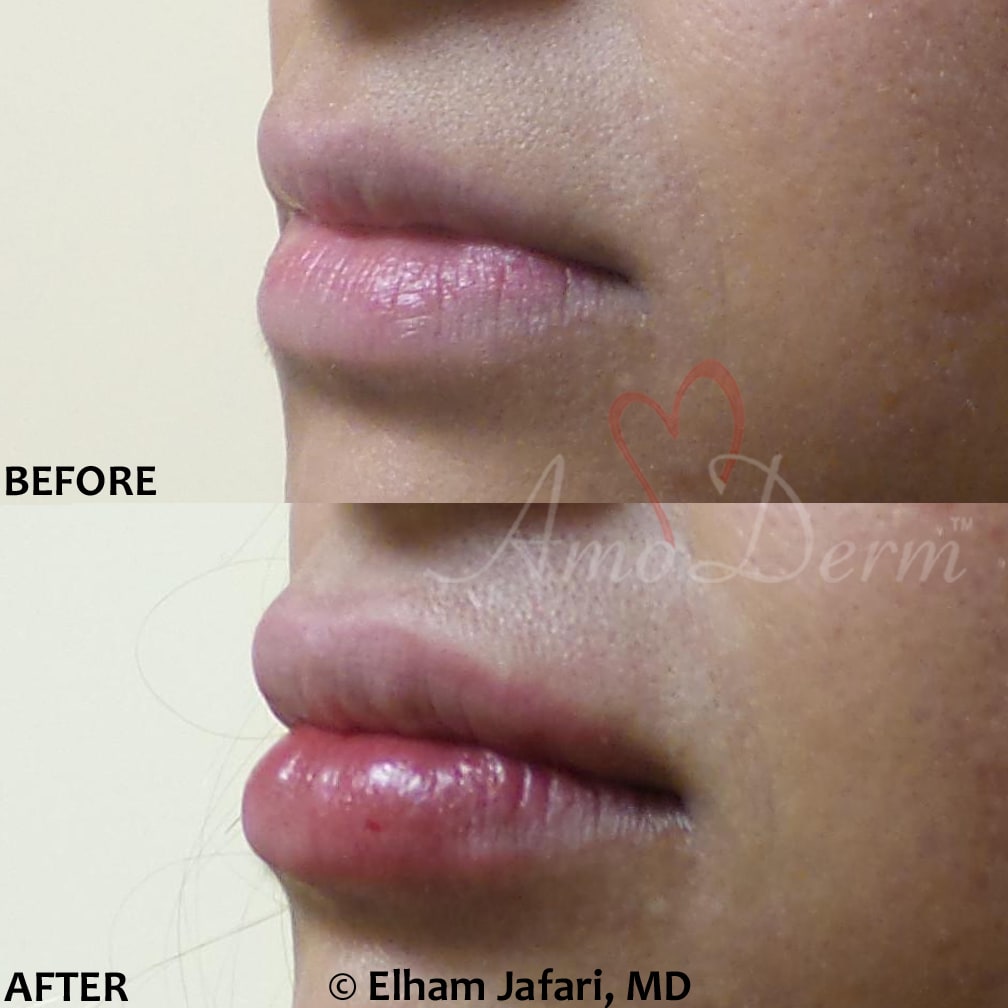 Lip augmentation with hyaluronic acid filler