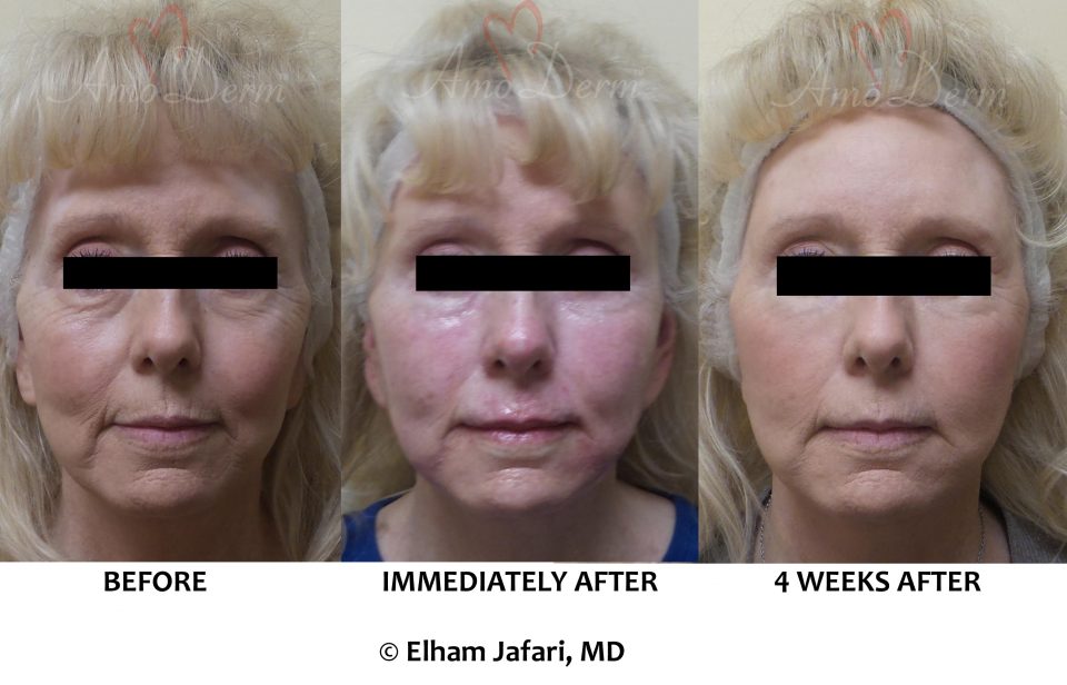 Liquid Facelift with filler injection in cheeks, jaw lines, Marionette lines & above lips