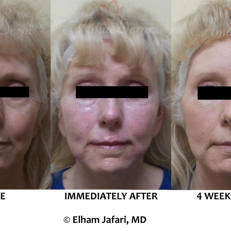Liquid Facelift with filler injection in cheeks, jaw lines, Marionette lines &amp; above lips