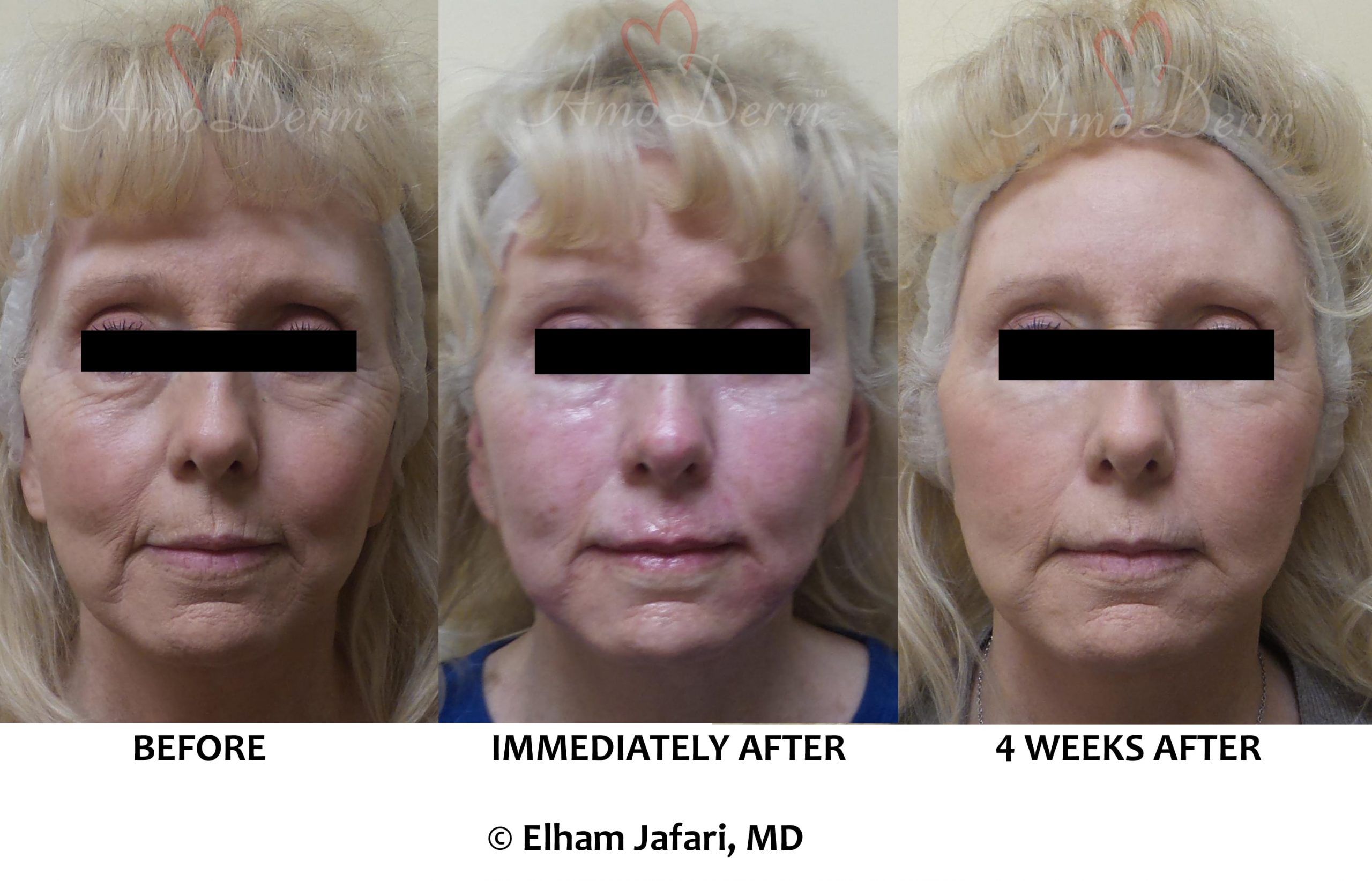 Liquid Facelift with filler injection in cheeks, jaw lines,