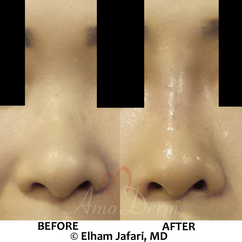 Nonsurgical Nose Job (Liquid Rhinoplasty) by Dr Jafari in Irvine