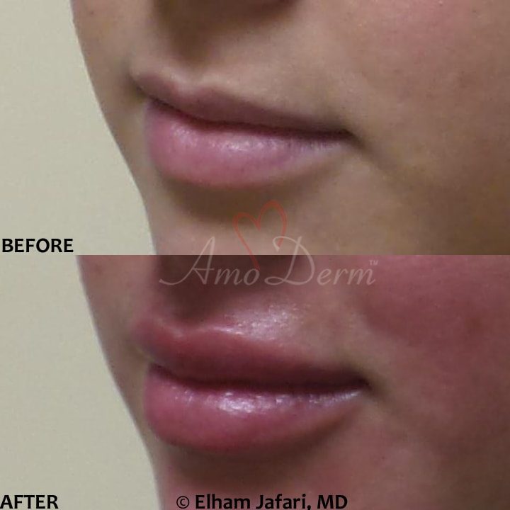 Lip Augmentation Irvine Lip Injections, Lip Fillers, Orange County