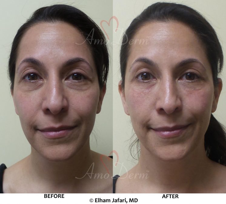 Treatment of dark circles, hollows or bags under eyes