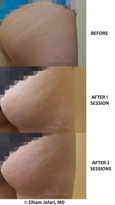 Treatment of stretch marks with Fractional CO2 laser (CO2 laser skin resurfacing)