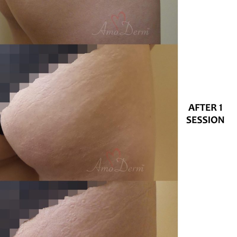 Treatment of stretch marks with Fractional CO2 laser (CO2 laser skin resurfacing)