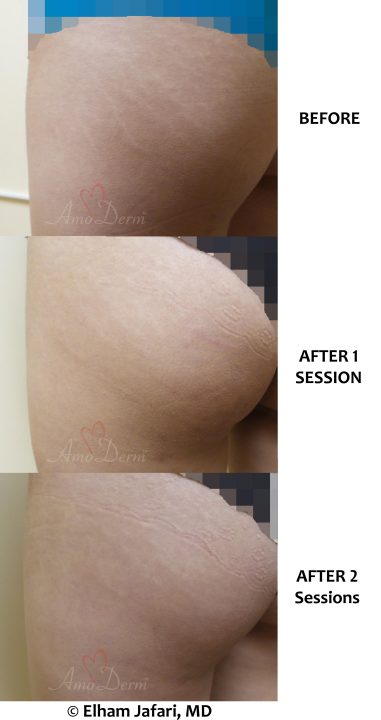 Treatment of stretch marks with Fractional CO2 laser (CO2 laser skin resurfacing)