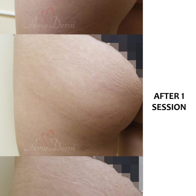 Treatment of stretch marks with Fractional CO2 laser (CO2 laser skin resurfacing)