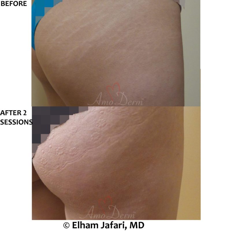 Treatment of stretch marks with Fractional CO2 laser (CO2 laser skin resurfacing)