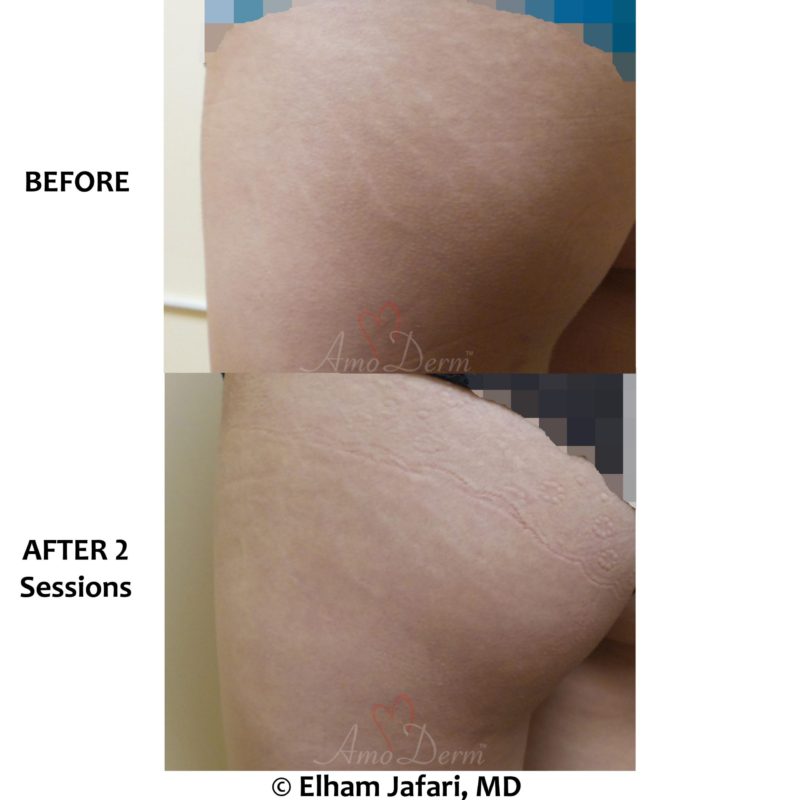 Treatment of stretch marks with Fractional CO2 laser (CO2 laser skin resurfacing)