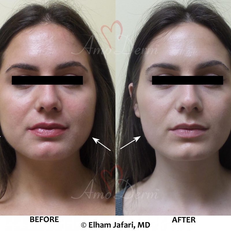 Facial slimming (jaw slimming or jaw reduction) is known as cosmetic facial injection