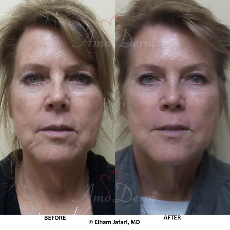 Liquid Facelift with Botox &amp; filler injection in various areas including jawlines, under the eyes &amp; cheeks