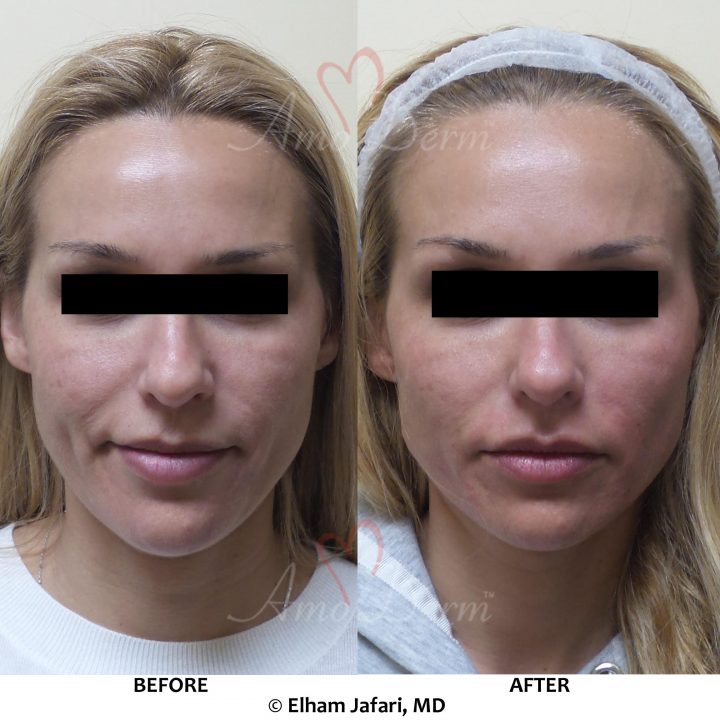 Liquid Facelift with PDO Thread (thread lift) in mid and lower face