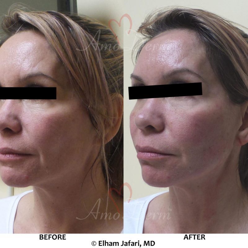 Liquid Facelift with PDO Thread (thread lift) in mid and lower face