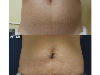 SculpSure Stubborn Fat Reduction and Stretch Marks Treatment of stretch marks with CO2 laser & non-surgical removal of stubborn fat in belly with SculpSure