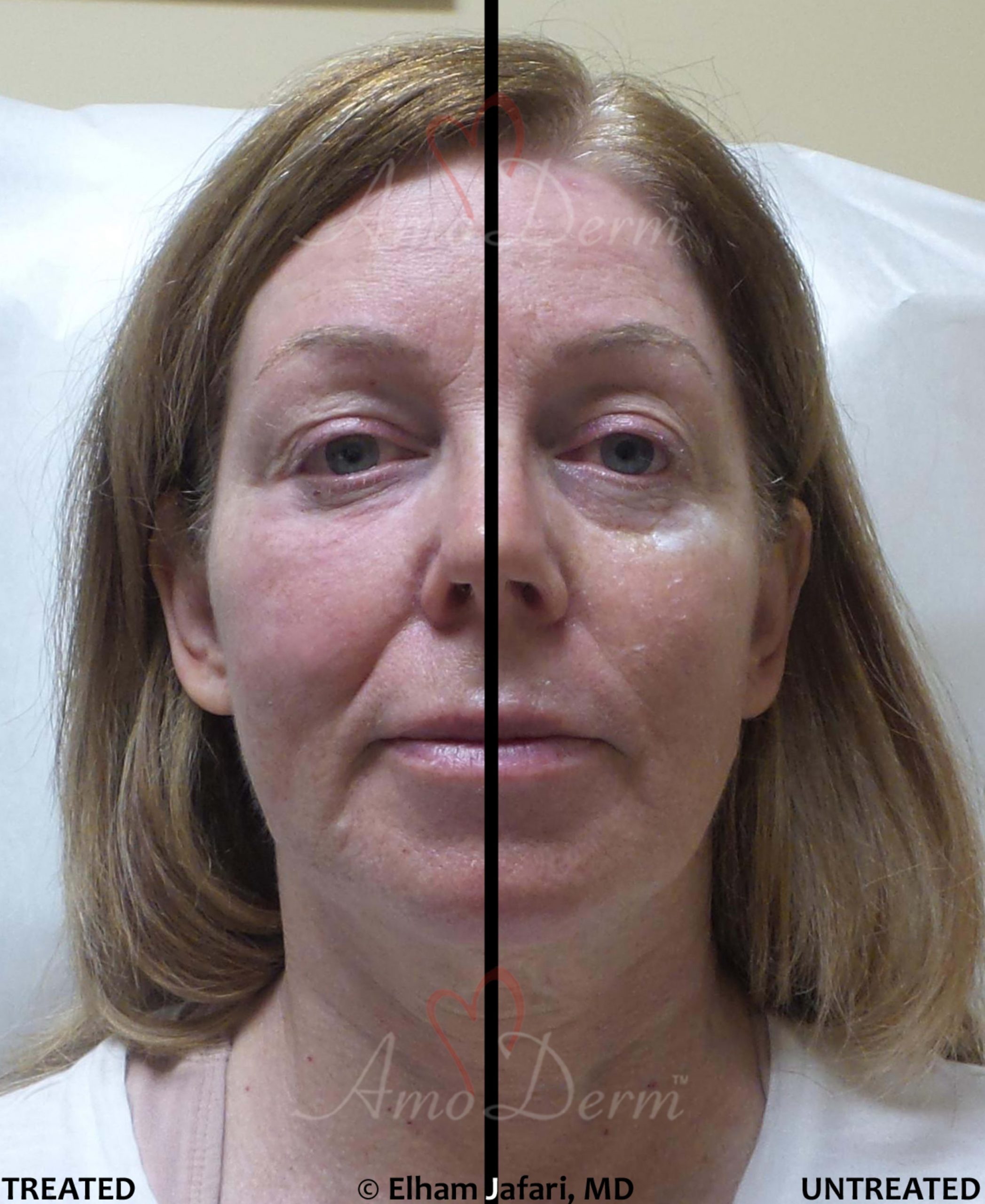 Liquid facelift with filler under eyes, cheek restoration and lip