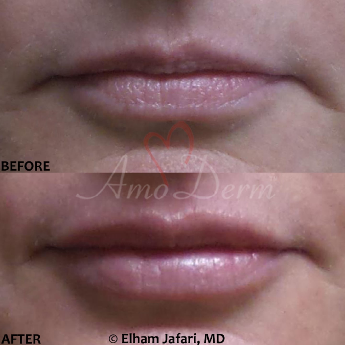 Lip Augmentation Irvine Lip Injections, Lip Fillers, Orange County