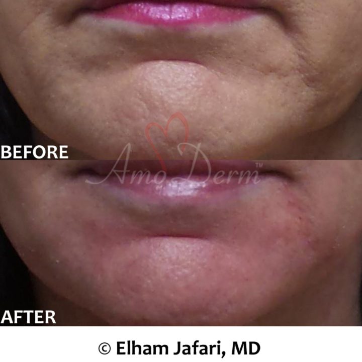 Treatment of Marionette lines with filler injection (Juvederm, Vollure, Restylane, Radiesse, Bellafill)