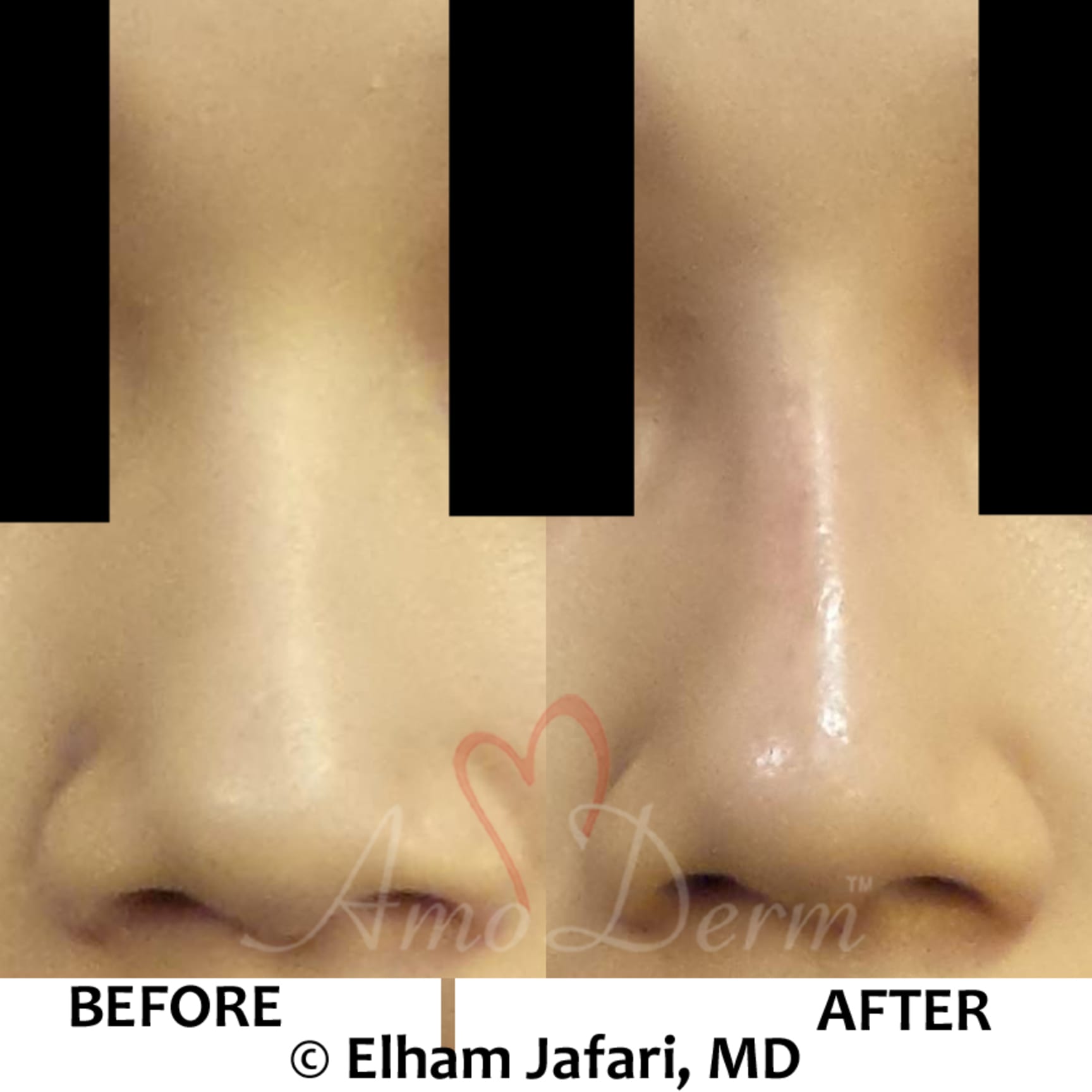 Nonsurgical Nose Job Liquid Rhinoplasty Before and After Pictures