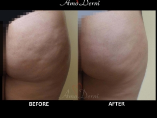 Cellulite treatment in buttocks with Sculptra filler injection as part of Brazilian Butt Lift