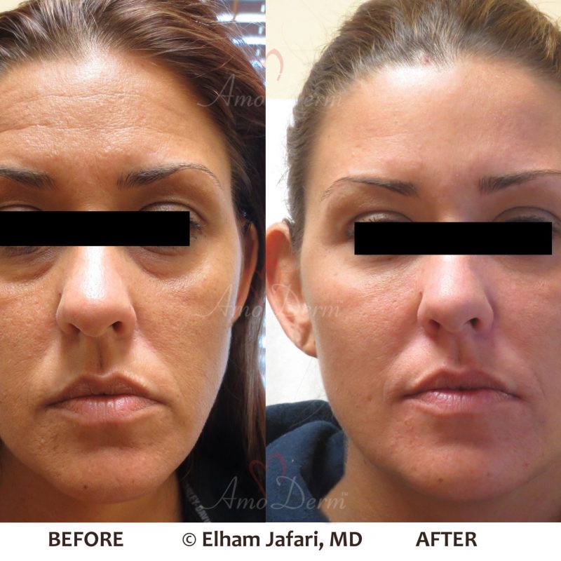 Liquid Facelift and Dark Circles Under Eyes