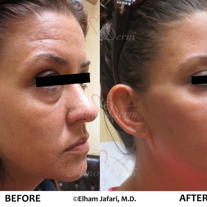Liquid Facelift and Dark Circles Under Eyes