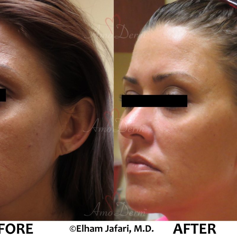 Liquid Facelift and Dark Circles Under Eyes