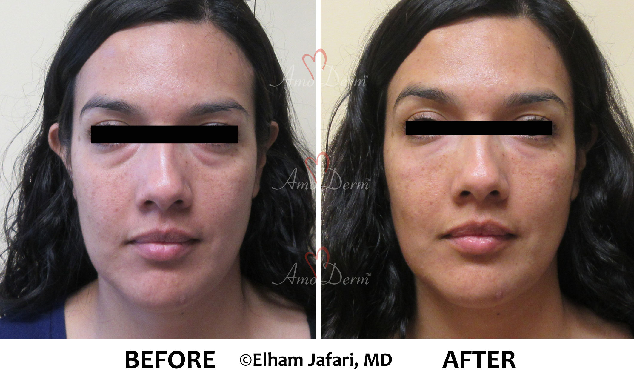 Dark Circles Under Eyes Treatments Before and After Pictures