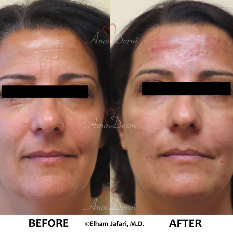 Liquid Facelift and Dark Circles Under Eyes