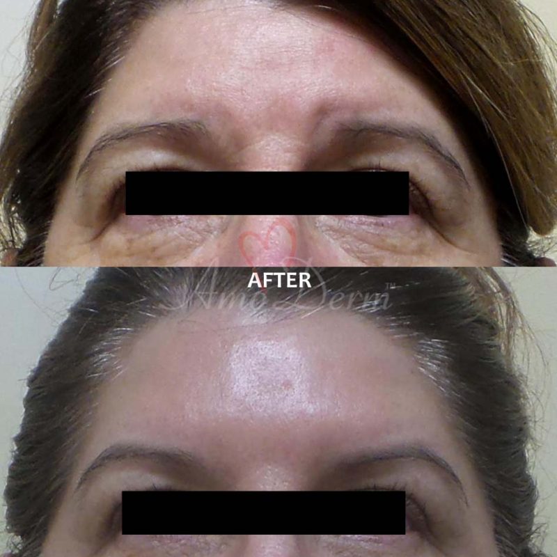 Botox Cosmetic Treatments