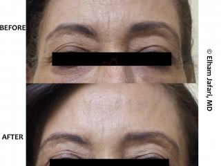 Botox with filler injection