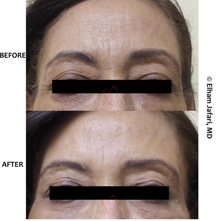 Botox with filler injection