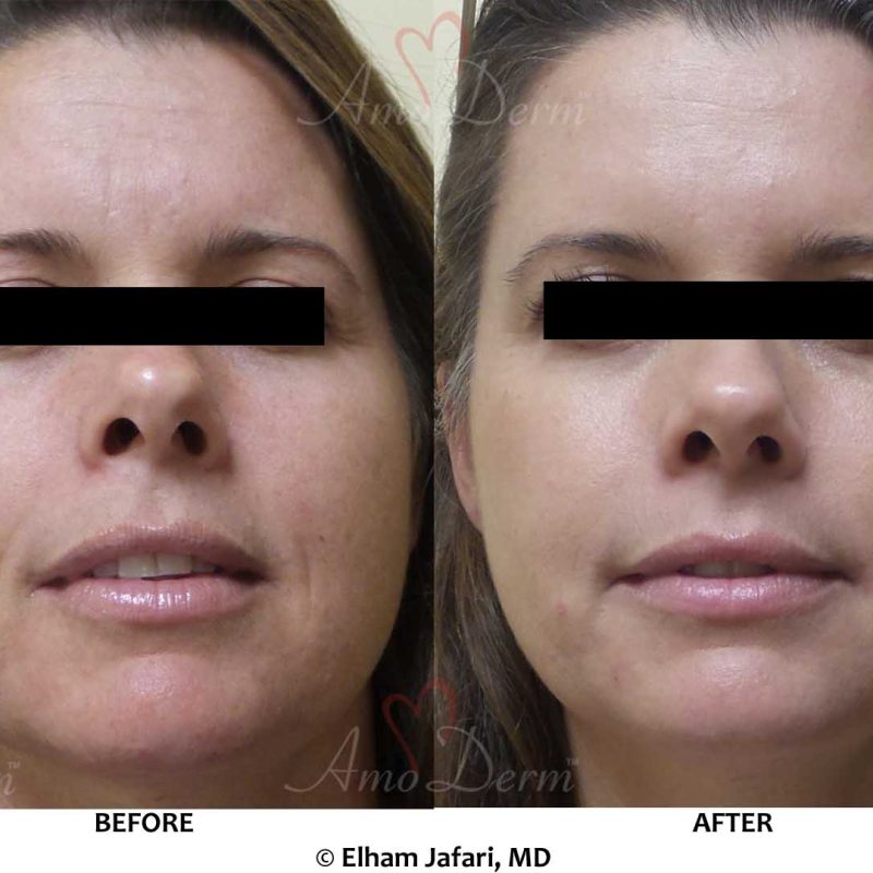 Botox Filler Erbium