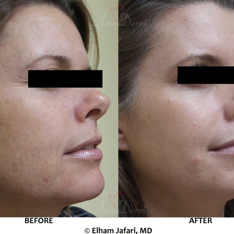 Botox Filler Erbium