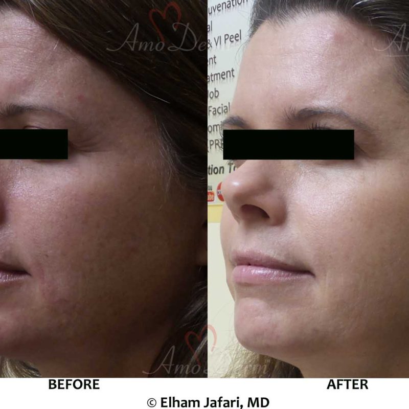 Botox Filler Erbium