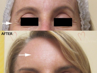Botox in Forehead Crows Feet &amp; Glabella