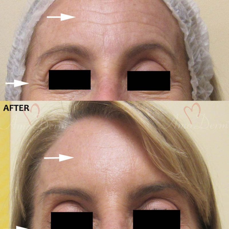 Botox in Forehead Crows Feet &amp; Glabella