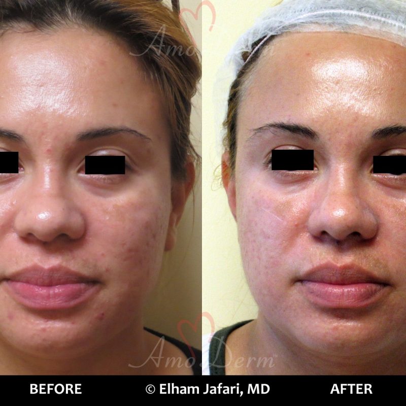 Fractional CO2 Laser