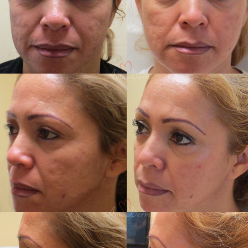 Fractional CO2 Laser Skin Resurfacing Cosmetic Treatments Before and After Pictures Fractional CO2 Laser Skin Resurfacing