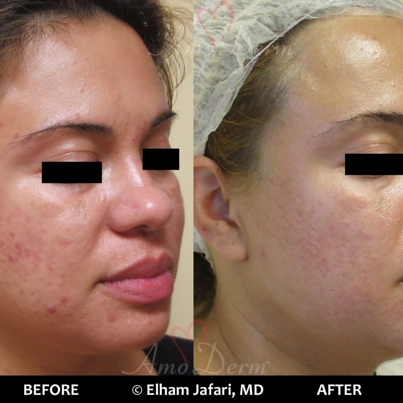 Fractional CO2 Laser